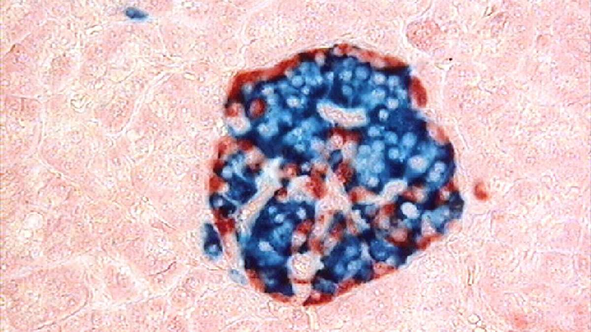 3D printed pancreatic islets for diabetes therapy