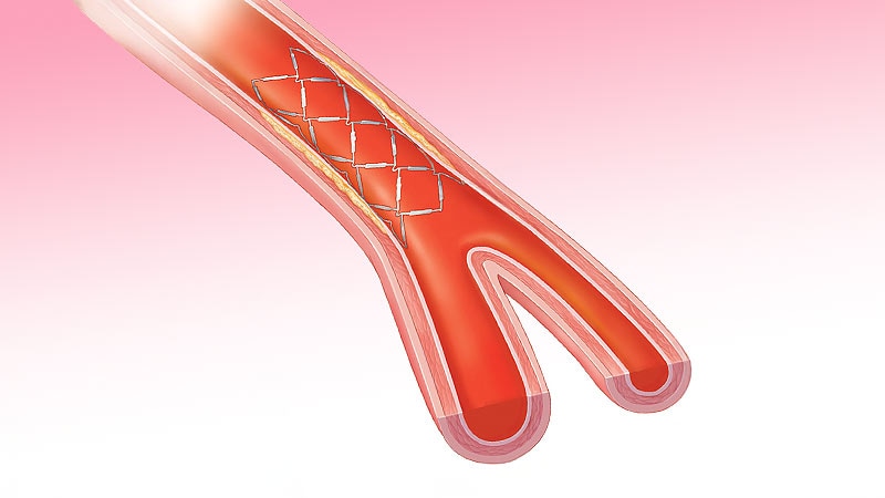 From Real-Time Glucose Tracking to Policy Wins: Diabetes News You Need Today 3 3D rendered glove symbolizing preventive PCI outcomes in diabetes