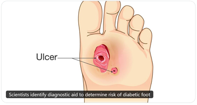 Illustration of skin barrier function test to prevent diabetic foot ulcer recurrence
