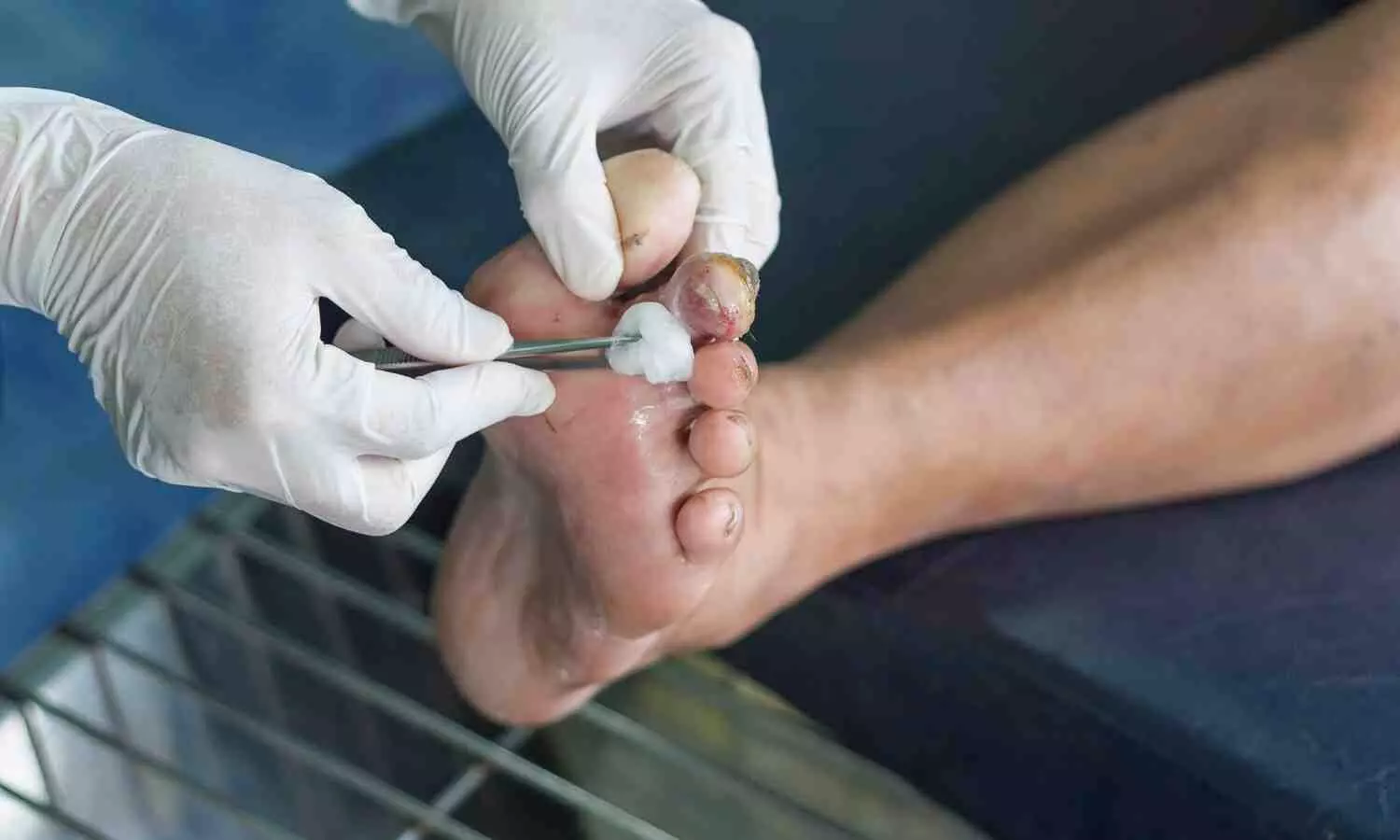 Immune-regulating hydrogel application for diabetic foot ulcer healing