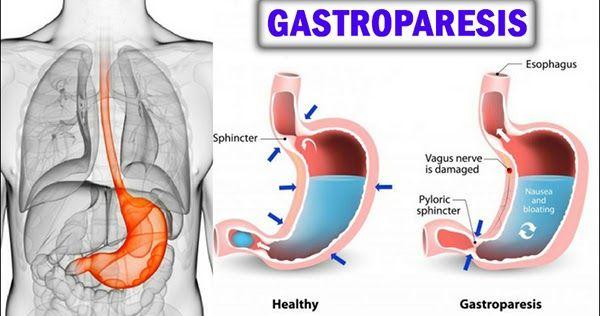 Illustration of diabetic gastroparesis stomach functions