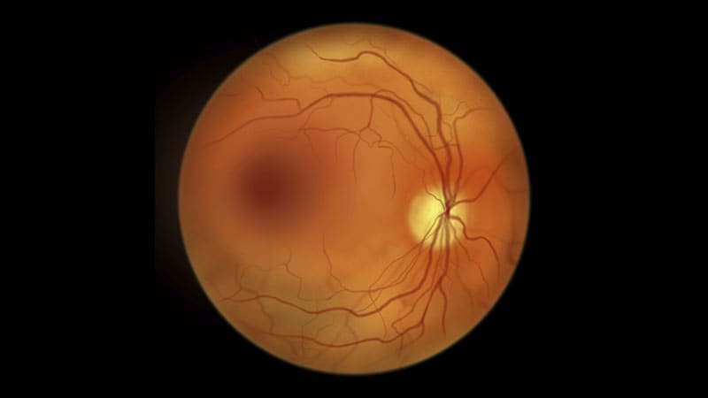 Unexpected Heroes and Game-Changing Diabetes Discoveries from Today 6 Diabetic macular edema impact on eye