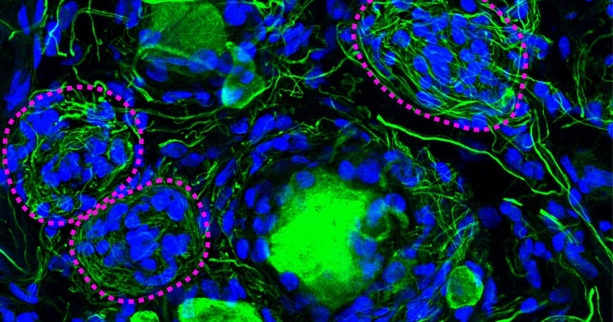Nageotte nodules molecular structure in diabetic neuropathy