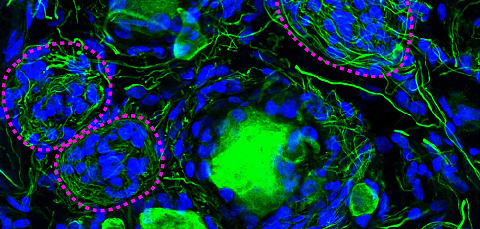 Nerve tissue Nageotte nodules linked to diabetic neuropathy