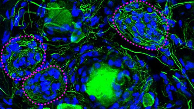 Cell clusters called Nageotte nodules linked to diabetic neuropathy pain