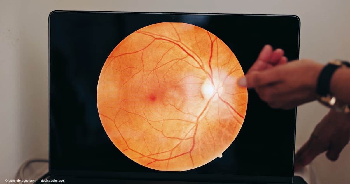 Retinal OCT scan showing diabetic retinopathy biomarkers