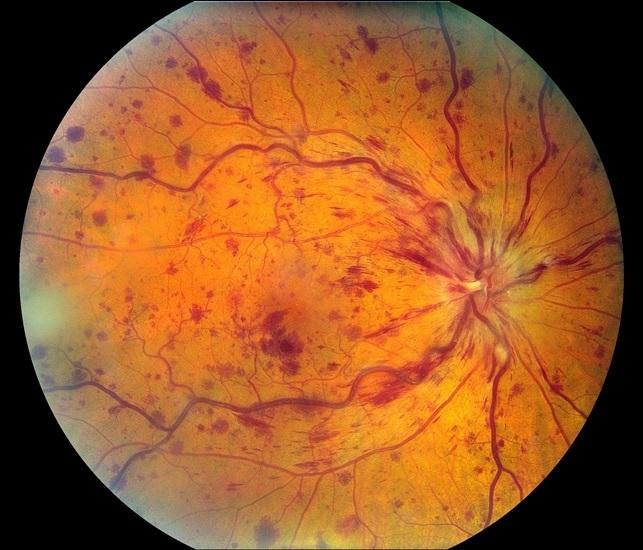 9 Critical Diabetes Updates You Can’t Afford to Miss Today 3 Diabetic retinopathy screening with digital fundus camera