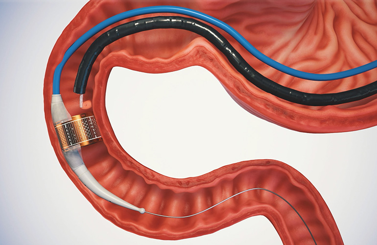 Endoscopic electroporation therapy boosts insulin sensitivity