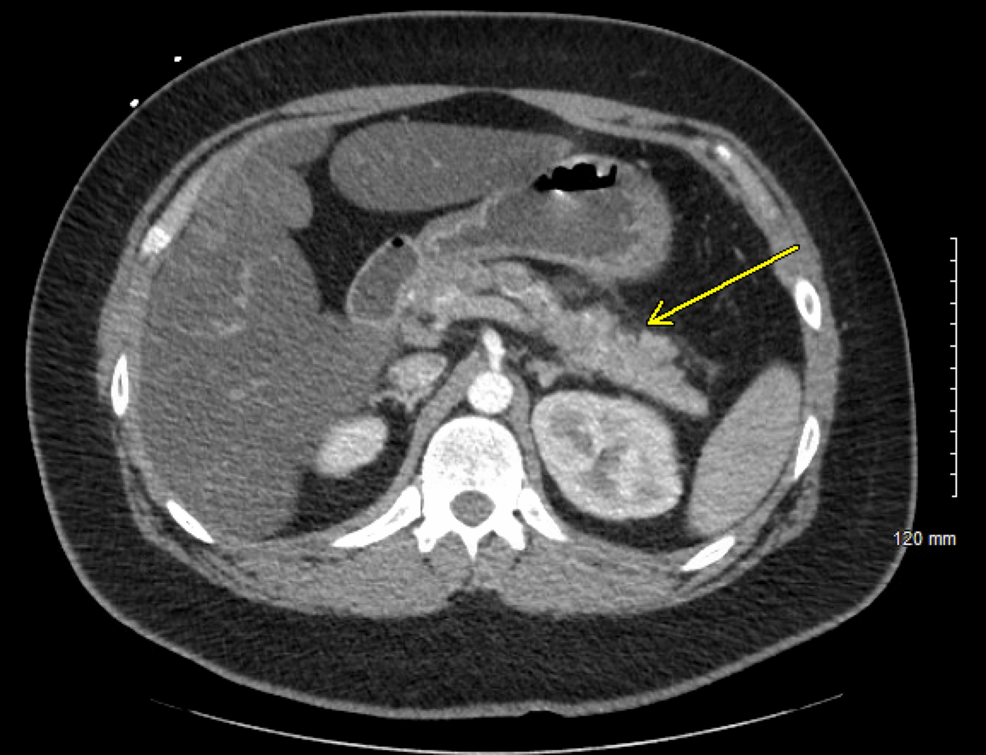 9 Critical Diabetes Updates You Can’t Afford to Miss Today 4 Abdominal scan highlighting pancreatitis in diabetes