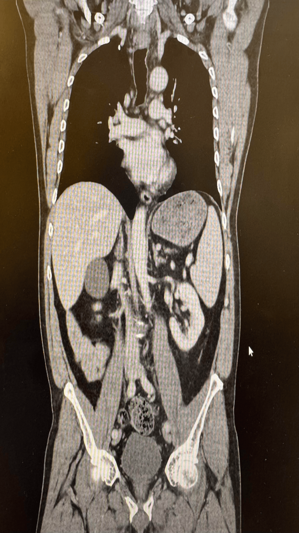 pembrolizumab side effects hypothyroidism diabetes
