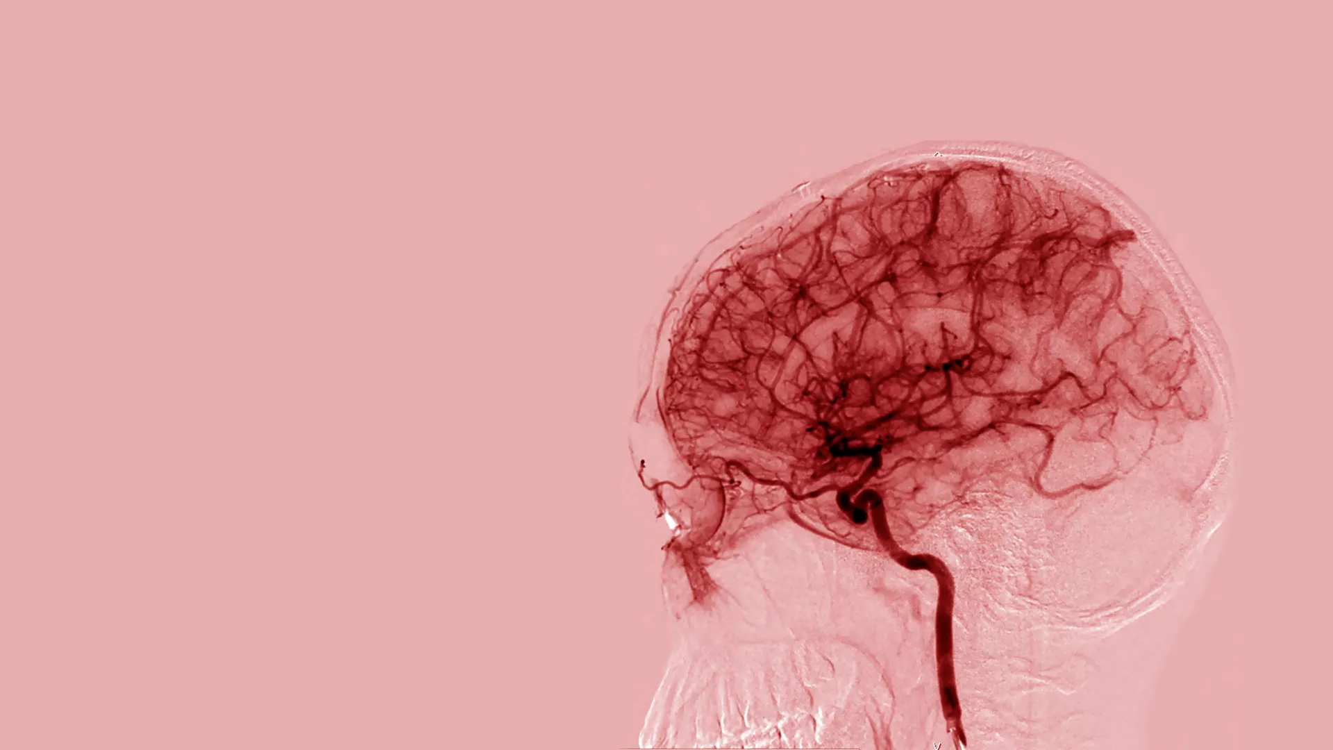 Stroke-heart syndrome risk factors in diabetic patients